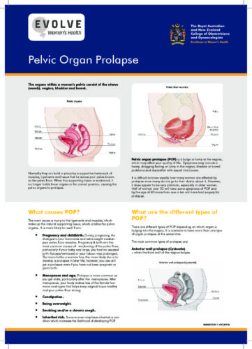 Pelvic Organ Prolapse - KK19 - Evolve Women's Health Toowoomba